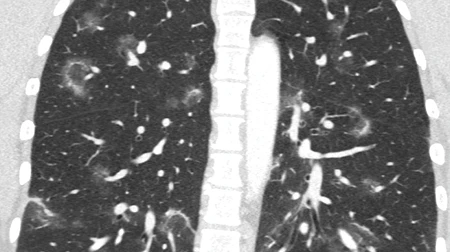 Expertise vertiefen: Die neue Zusatzqualifizierung Thoraxradiologie
